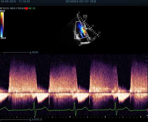 Aortic Regurgitation